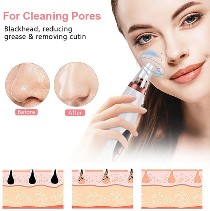 Rechargeable Blackhead Remover Vacuum – Pore Cleaner & Acne Extraction Tool